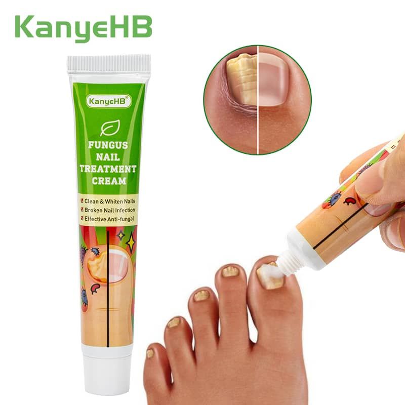 Crème de Traitement Antifongique  pour les Ongles des Pieds